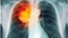 非吸烟者和青年也得肺癌 遗传密码解“肺癌之险”