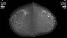 德国公司用AI分析乳房X光影像，已部署于该国超25%的乳腺癌筛查中心