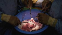 猪心移植再获突破，研究人员成功将猪心移植到两位死者体内