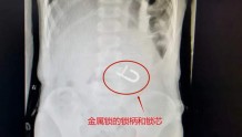 西安大兴医院：5岁男孩误吞“金属锁”，胃镜下1分钟取出