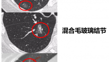 CT发现这样的肺炎请小心，它可能是肺癌，而且恶性度很高！！！