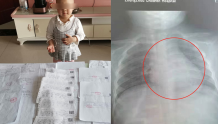 3岁女童胸腔肿瘤如成人拳头大小