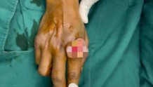 “手痒”2年，竟然是癌？！高温天里更要警惕这件事！